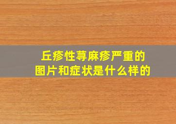 丘疹性荨麻疹严重的图片和症状是什么样的