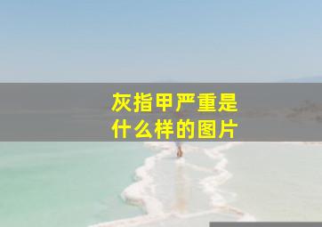 灰指甲严重是什么样的图片