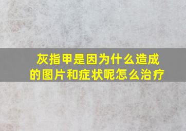 灰指甲是因为什么造成的图片和症状呢怎么治疗