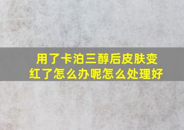 用了卡泊三醇后皮肤变红了怎么办呢怎么处理好