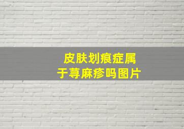 皮肤划痕症属于荨麻疹吗图片