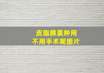 皮脂腺囊肿用不用手术呢图片