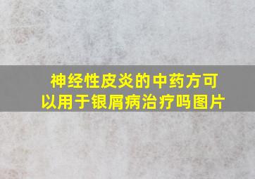 神经性皮炎的中药方可以用于银屑病治疗吗图片