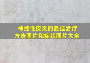 神经性皮炎的最佳治疗方法图片和症状图片大全