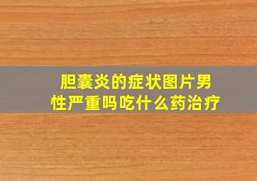 胆囊炎的症状图片男性严重吗吃什么药治疗