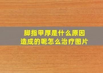 脚指甲厚是什么原因造成的呢怎么治疗图片