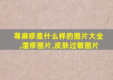 荨麻疹是什么样的图片大全,湿疹图片,皮肤过敏图片