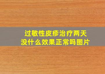 过敏性皮疹治疗两天没什么效果正常吗图片