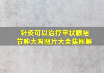 针灸可以治疗甲状腺结节肿大吗图片大全集图解