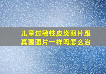 儿童过敏性皮炎图片跟真菌图片一样吗怎么治