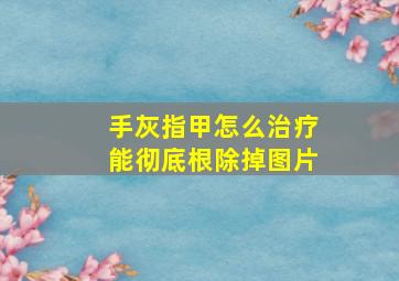 手灰指甲怎么治疗能彻底根除掉图片