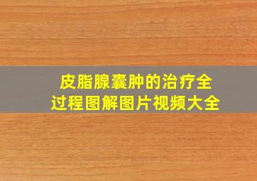 皮脂腺囊肿的治疗全过程图解图片视频大全